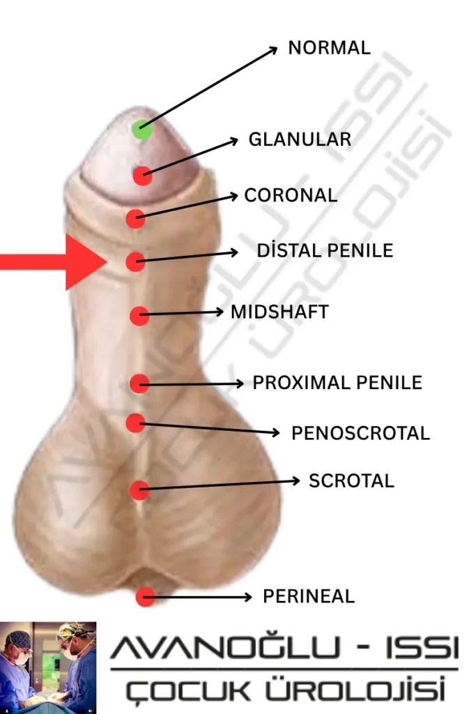 Distal hipospadias nedir